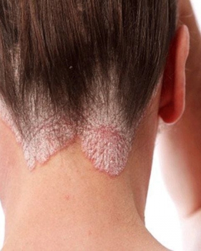 Điều Trị Bệnh Lý Da Đầu